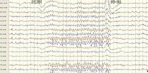 成人普通脑电图操作视频,成人普通脑电图操作步骤详解